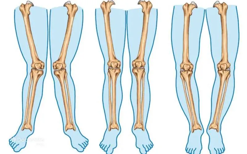 انحراف زانو