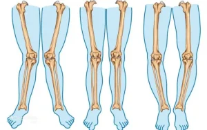 عوارض انحراف زانو