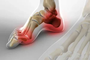 گودی و قوس زیاد کف پا