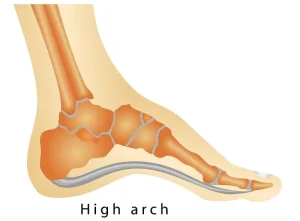 قوس بلند کف پا