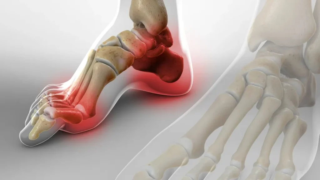 گودی و قوس زیاد کف پا